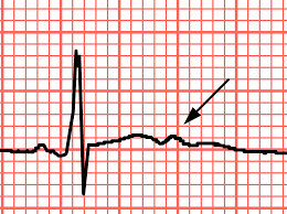 ipopotassemia-ecg-opi-teramo